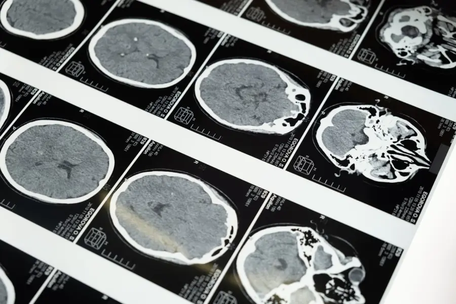 Tumori cerebrali pediatrici, Sapienza scopre nuovo ruolo di AMBRA1
