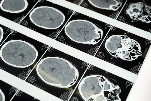 Tumori cerebrali pediatrici, Sapienza scopre nuovo ruolo di AMBRA1