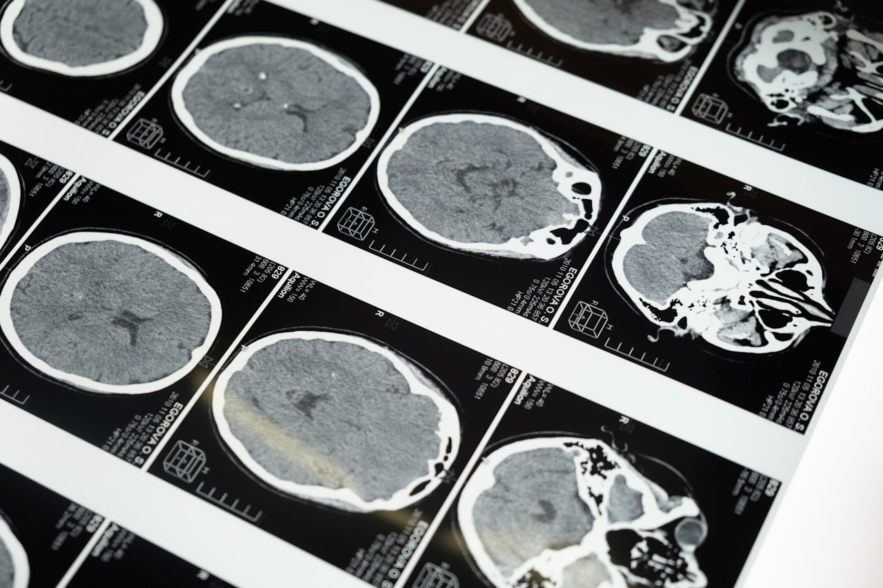 Tumori cerebrali pediatrici, Sapienza scopre nuovo ruolo di AMBRA1