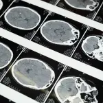 Tumori cerebrali pediatrici, Sapienza scopre nuovo ruolo di AMBRA1